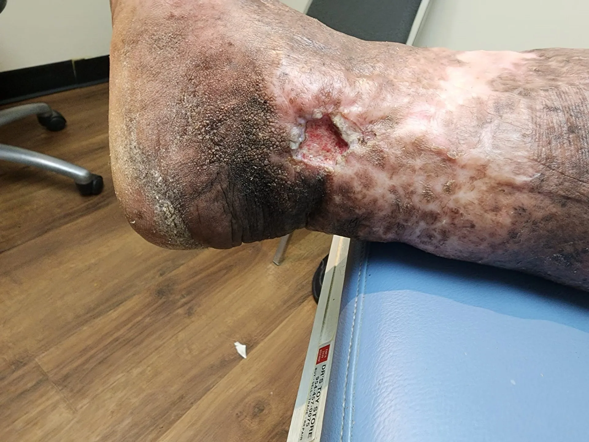 wound care pompano beach